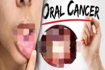 வாய்ப் புற்றுநோயால் நாட்டில் நாளாந்தம் மூன்று பேர் பலி