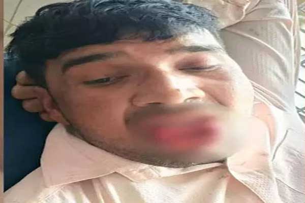 முத்தம் கொடுக்கப்போய் கள்ளக் காதலியிடம் உதட்டை இழந்தார்!